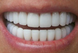 Виды отбеливания зубов