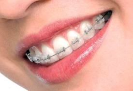 Брекеты - это качественное ортодонтическое лечение прикуса