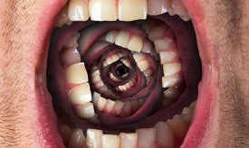 Гипердентия - аномалии количества зубов
