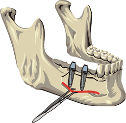Имплантация зубов при атрофии