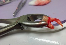 Как заживает рана после удаления зуба?