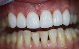 Реставрация зубов в Сумах