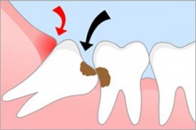 Основные рекомендации после удаления зубов мудрости